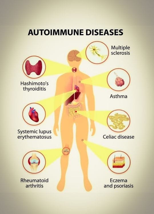 autoimmune diseases  Amgad Hazzaa