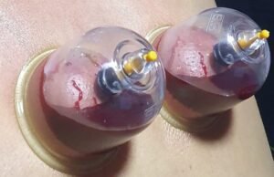 cupping therapy Diabetes mellites