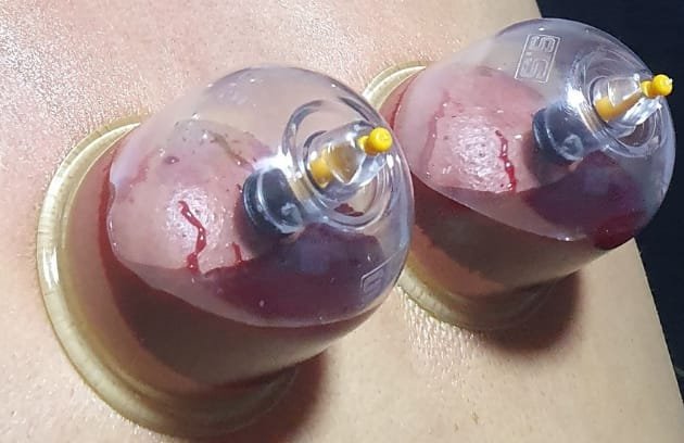 cupping therapy Diabetes mellites