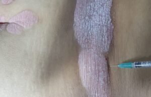 علاج الصدفية
