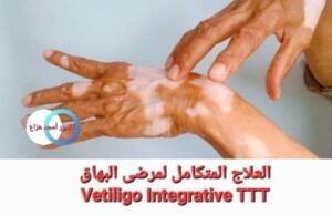 علاج البهاق نهائيا