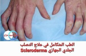 علاج تصلب الجلد