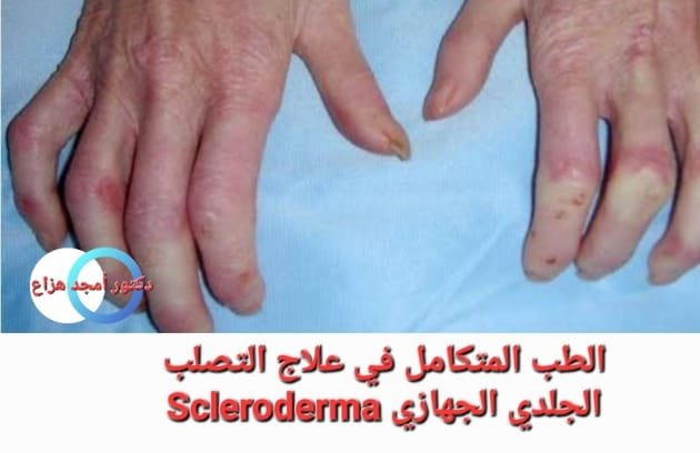 علاج تصلب الجلد