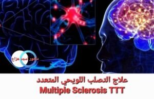 علاج التصلب اللويحي المتعدد
