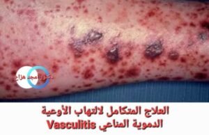 علاج التهاب الأوعية الدموية المناعي بالطب التكاملي