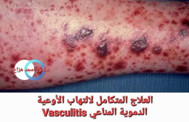 علاج التهاب الأوعية الدموية المناعي بالطب التكاملي