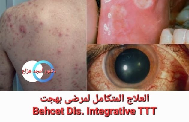 علاج مرض بهجت بالطب التكاملي