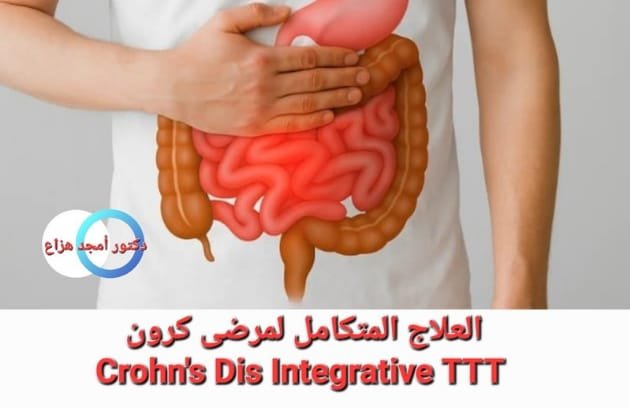 علاج مرض كرون