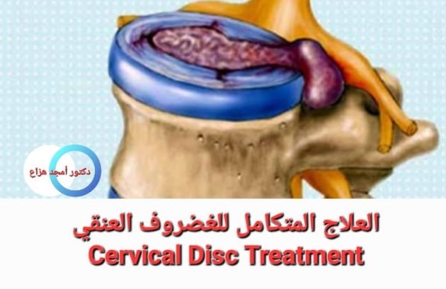 علاج انزلاق الغضروف العنقي