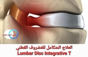 علاج الغضروف القطني نهائيا
