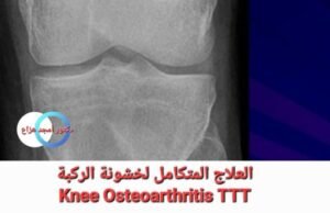 علاج خشونة الركبة بالطب التكاملي